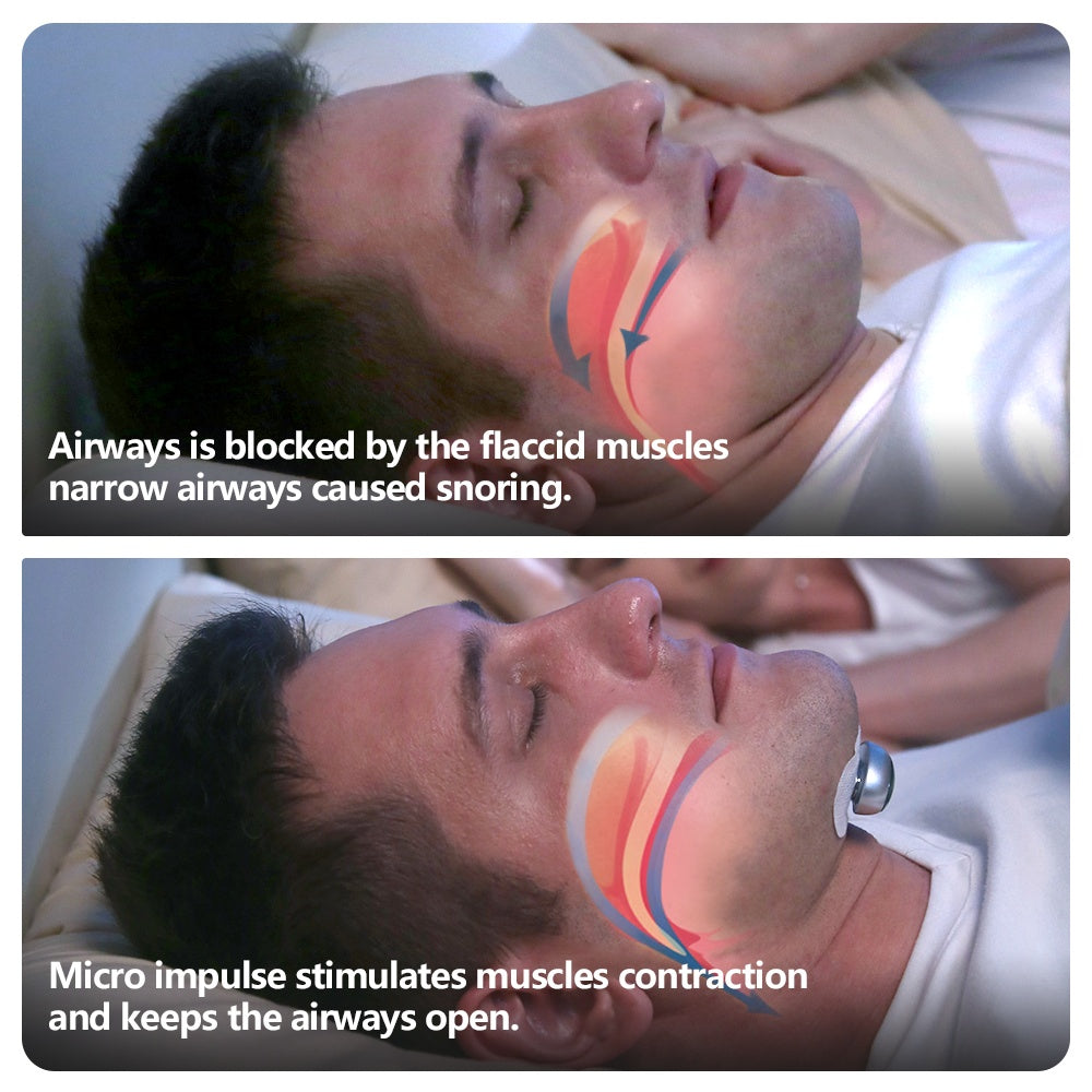 Electronic Muscle Stimulator for Snoring